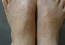 皮肤瘙痒的原因：13种病与此相关