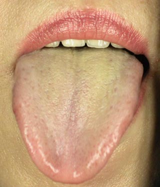 这种舌苔预示着胃病 要注意养胃了