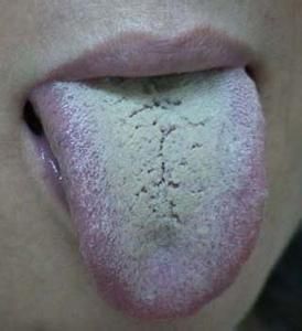 这种舌苔预示着胃病 要注意养胃了