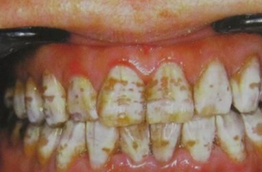 7种常见色素牙齿是病，看看你中招没有