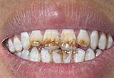 7种常见色素牙齿是病，看看你中招没有