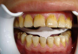 牙齿为什么总是会黄黄的呢？