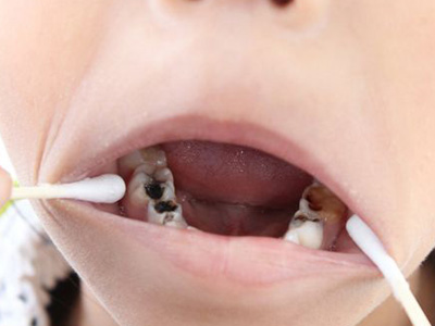 常吃甜食一定蛀牙？3种容易长蛀牙的方式你中了吗