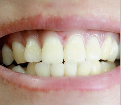 牙齿黄怎么办？常吃5种食物美白牙齿