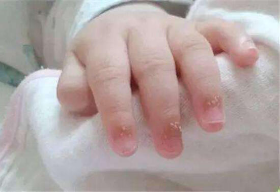 宝宝手指长倒刺有2个原因,家长应该这样避免 