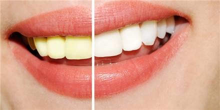  为什么牙齿总是黄黄的？牙黄怎么办？
