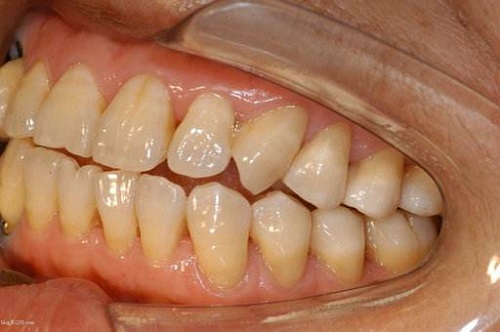  为什么牙齿总是黄黄的？牙黄怎么办？